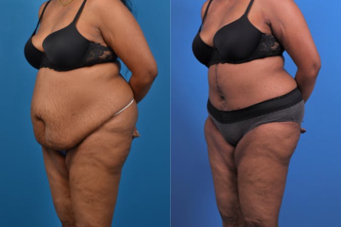 Tummy Tuck Before & After Gallery - Patient 122406804 - Image 3