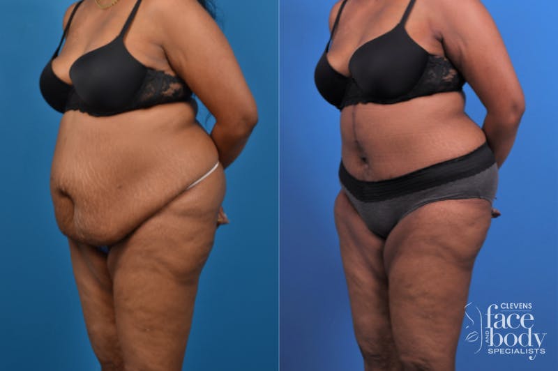 Hidden Tummy Tuck Before & After Gallery - Patient 426322 - Image 3