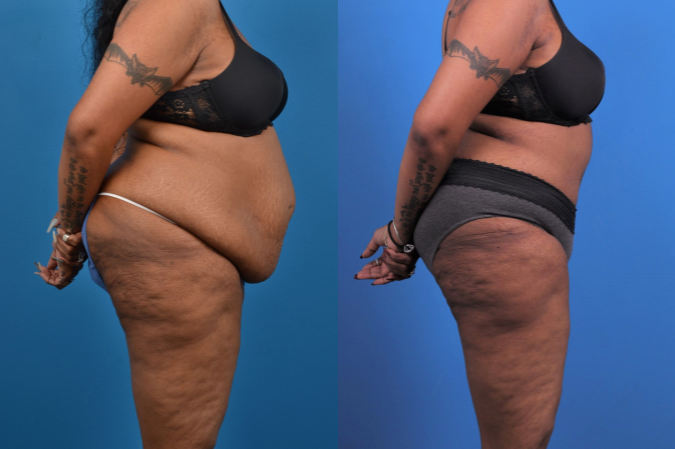 Hidden Tummy Tuck Before & After Gallery - Patient 426322 - Image 4