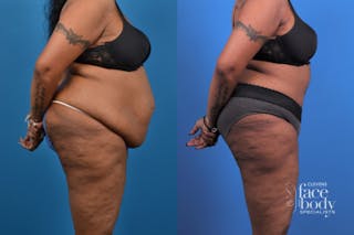 Hidden Tummy Tuck Before & After Gallery - Patient 426322 - Image 4