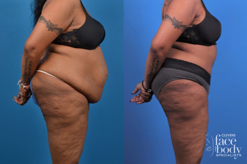 Hidden Tummy Tuck Before & After Gallery - Patient 426322 - Image 4