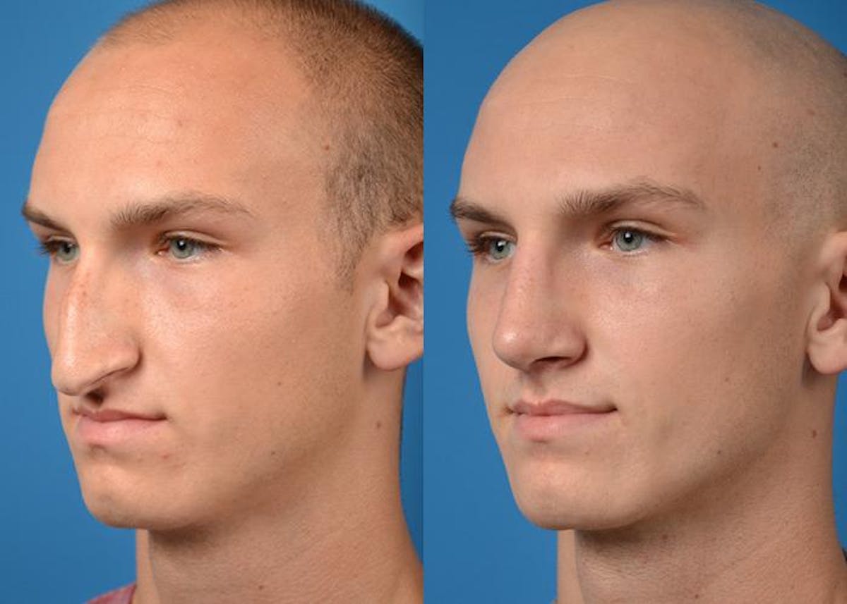 Rhinoplasty Before & After Gallery - Patient 122406805 - Image 4