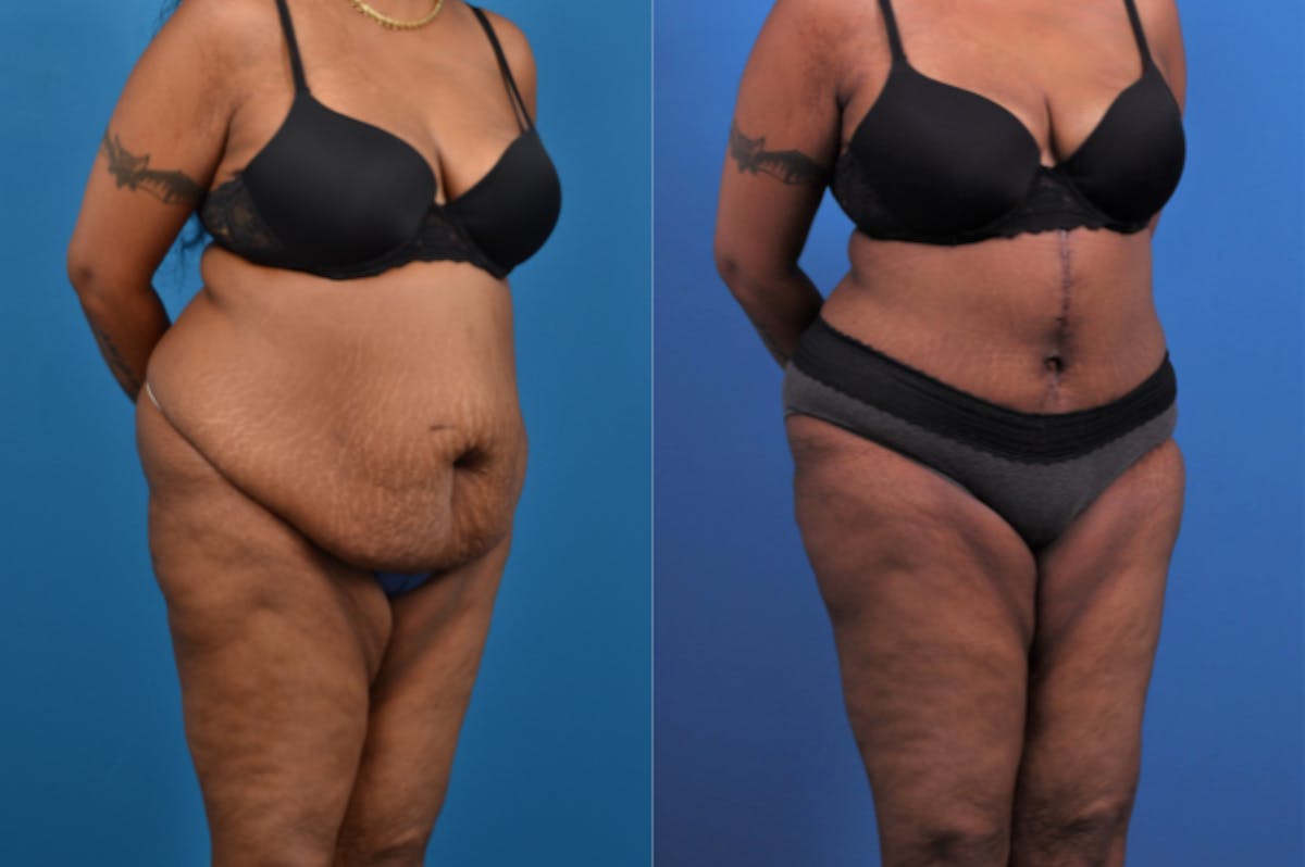 Tummy Tuck Before & After Gallery - Patient 177063 - Image 5