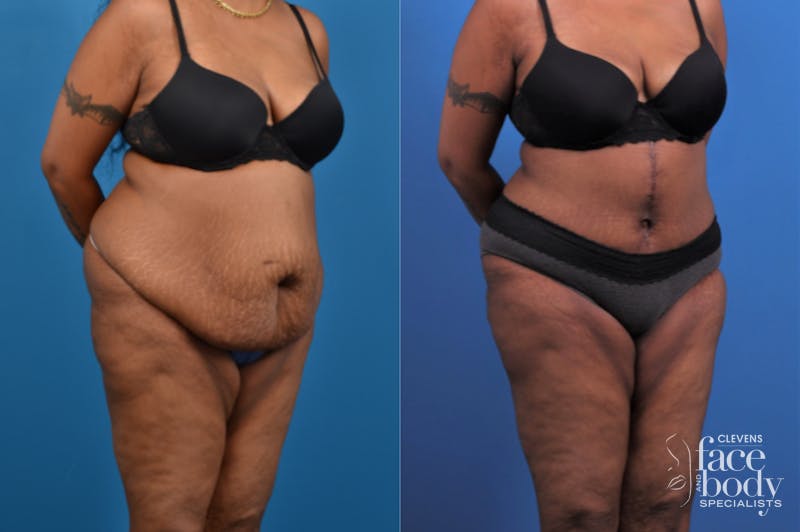 Hidden Tummy Tuck Before & After Gallery - Patient 426322 - Image 5
