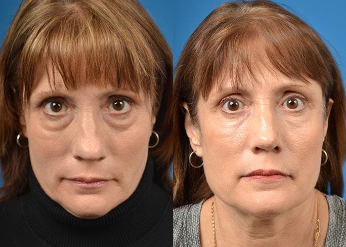 Rhinoplasty Before & After Gallery - Patient 122406807 - Image 1