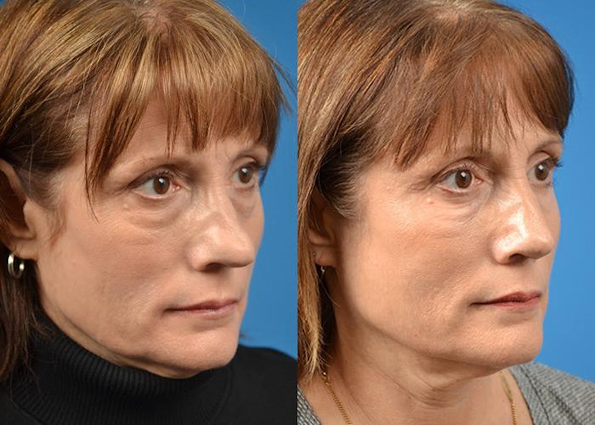 Rhinoplasty Before & After Gallery - Patient 122406807 - Image 2