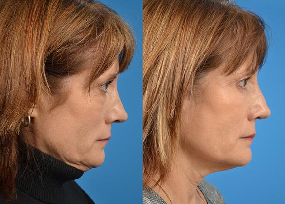Rhinoplasty Before & After Gallery - Patient 122406807 - Image 3