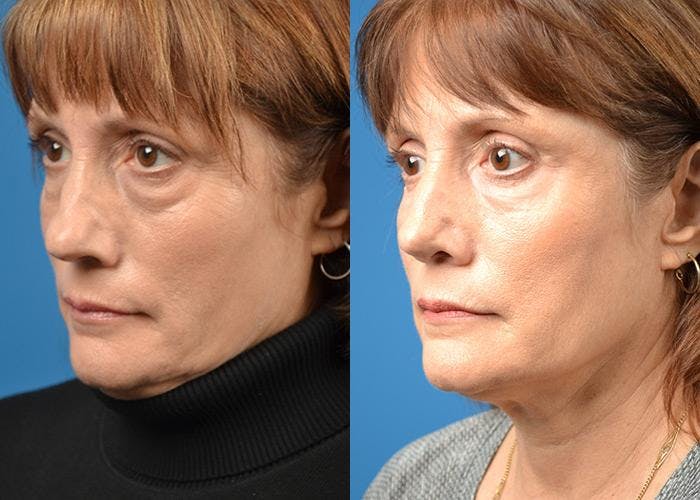 Rhinoplasty Before & After Gallery - Patient 122406807 - Image 4