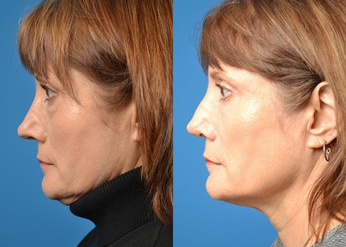 Rhinoplasty Before & After Gallery - Patient 122406807 - Image 5