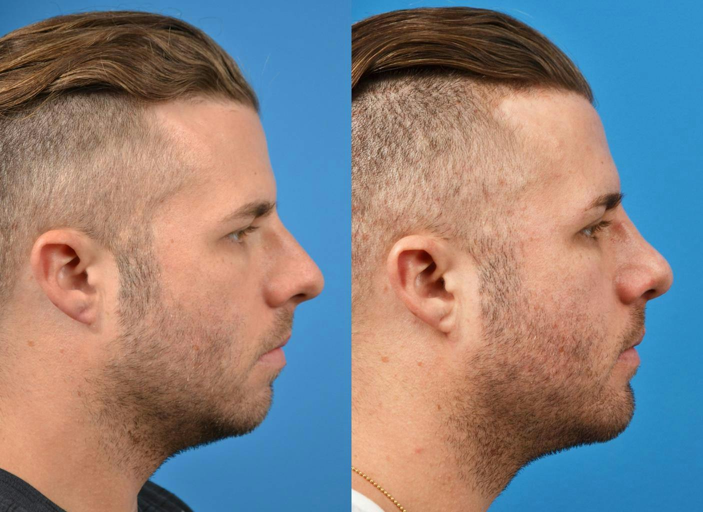 Rhinoplasty Before & After Gallery - Patient 122406815 - Image 2