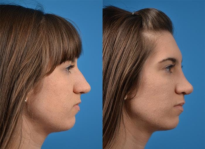 Rhinoplasty Before & After Gallery - Patient 122406819 - Image 1