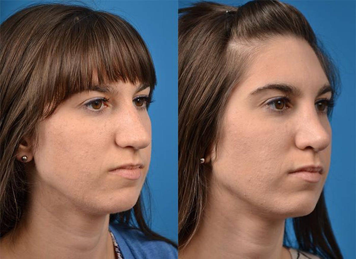 Rhinoplasty Before & After Gallery - Patient 122406819 - Image 2