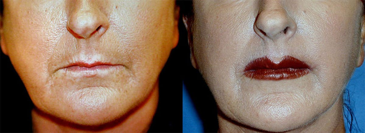 Lip Lift Before & After Gallery - Patient 122406816 - Image 1