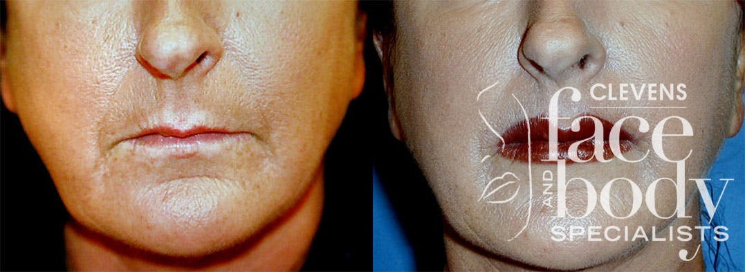 Lip Lift