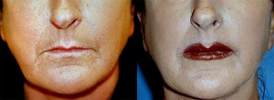 Lip Lift Before & After Gallery - Patient 122406816 - Image 1