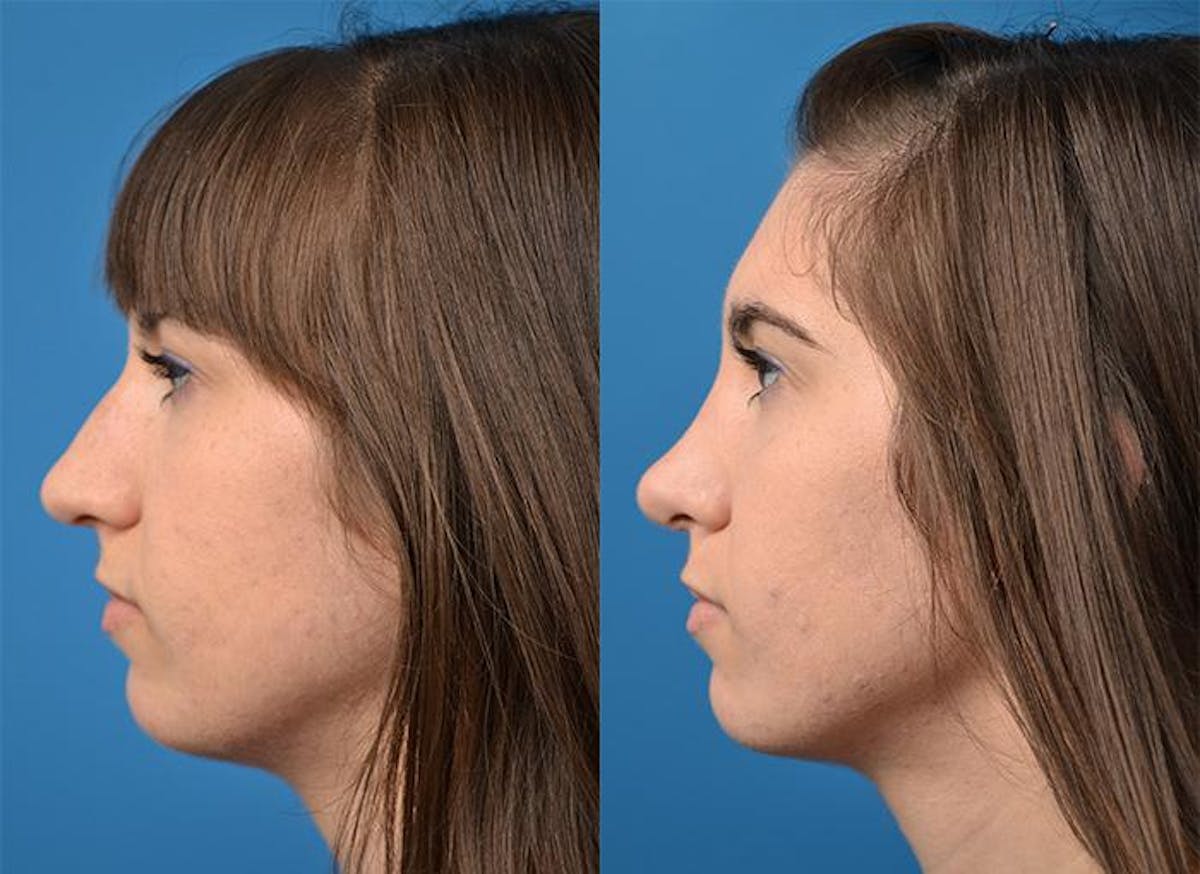 Rhinoplasty Before & After Gallery - Patient 122406819 - Image 3