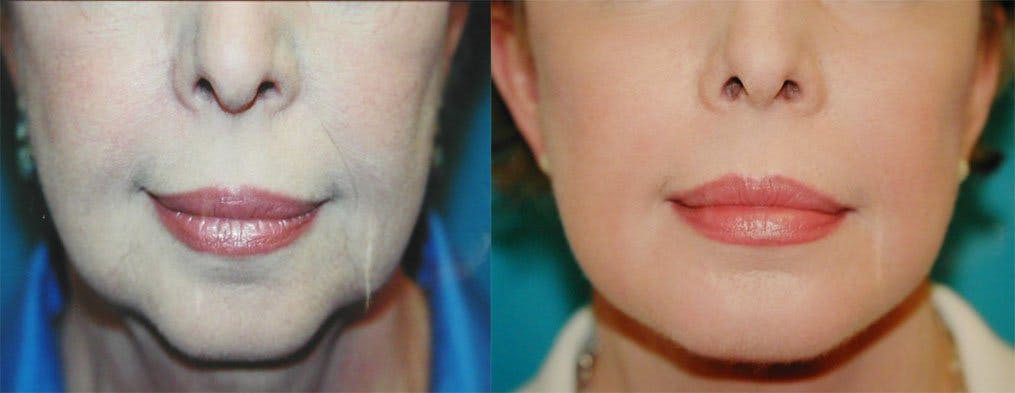 Lip Lift Before & After Gallery - Patient 122406818 - Image 1