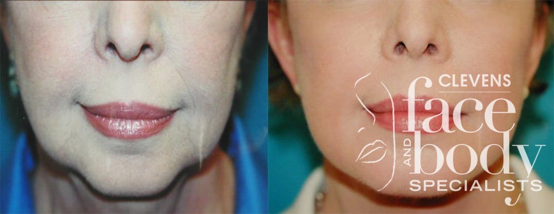 Lip Lift