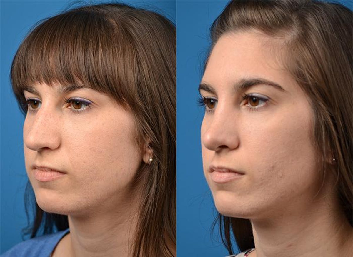 Rhinoplasty Before & After Gallery - Patient 122406819 - Image 4