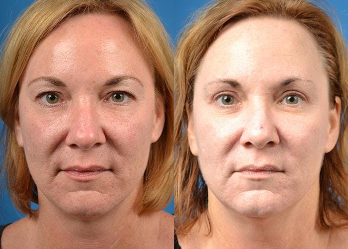 Skin Resurfacing Before & After Gallery - Patient 122406821 - Image 1