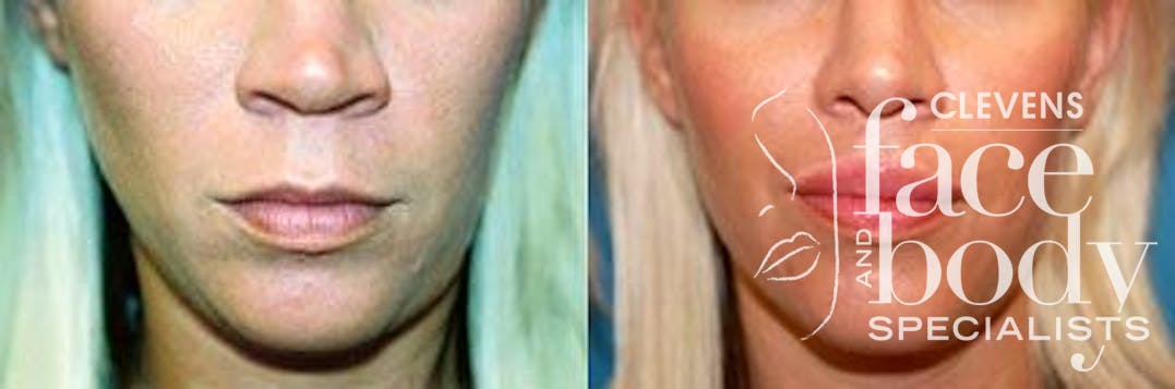 Lip Lift