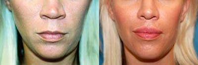 Lip Lift Before & After Gallery - Patient 122406820 - Image 1