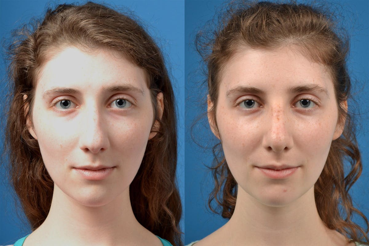 Rhinoplasty Before & After Gallery - Patient 122406825 - Image 1