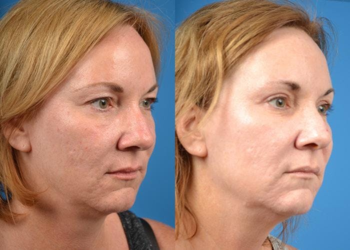 Skin Resurfacing Before & After Gallery - Patient 122406821 - Image 2