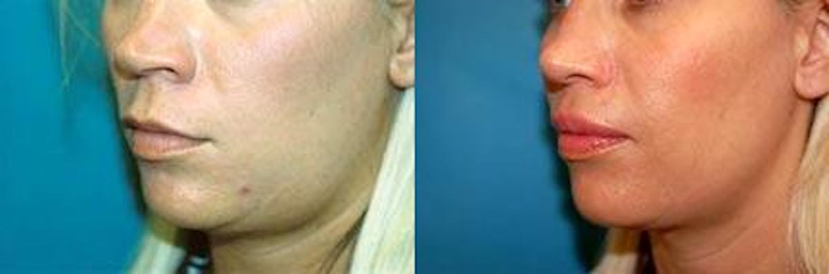 Lip Lift Before & After Gallery - Patient 122406820 - Image 2