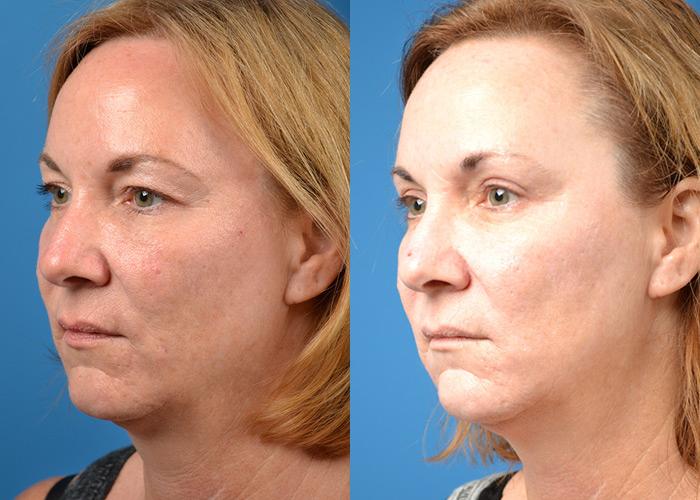 Skin Resurfacing Before & After Gallery - Patient 122406821 - Image 3