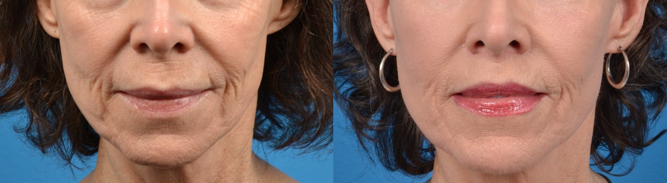 Lip Lift Before & After Gallery - Patient 122406822 - Image 1