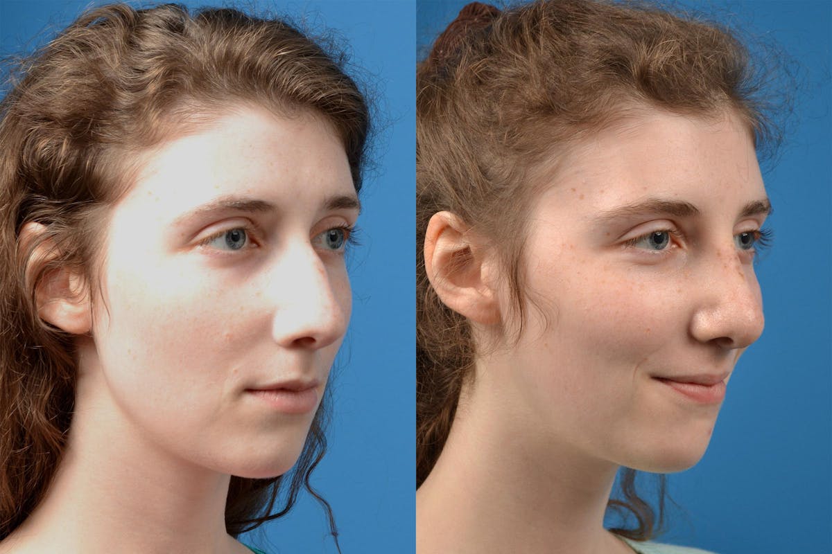 Rhinoplasty Before & After Gallery - Patient 122406825 - Image 2