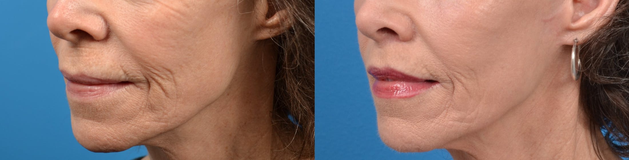 Lip Lift Before & After Gallery - Patient 122406822 - Image 2