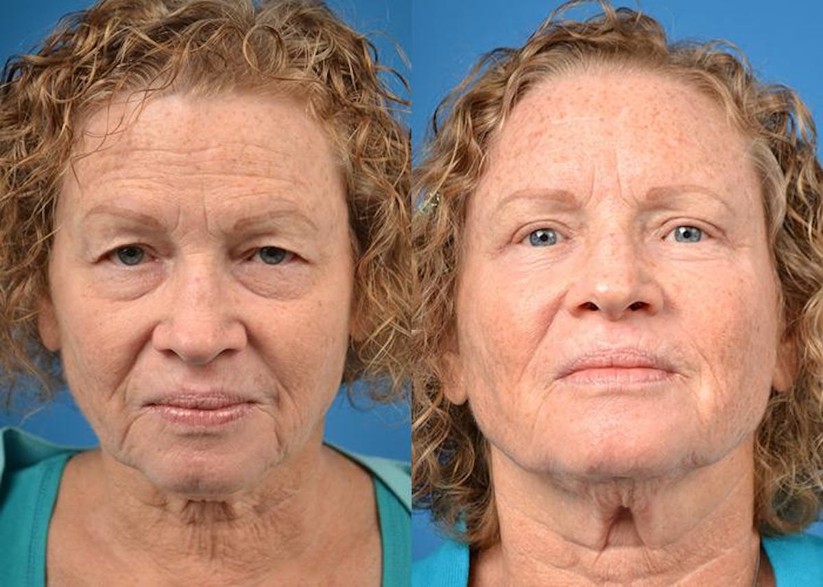 Skin Resurfacing Before & After Gallery - Patient 122406823 - Image 1