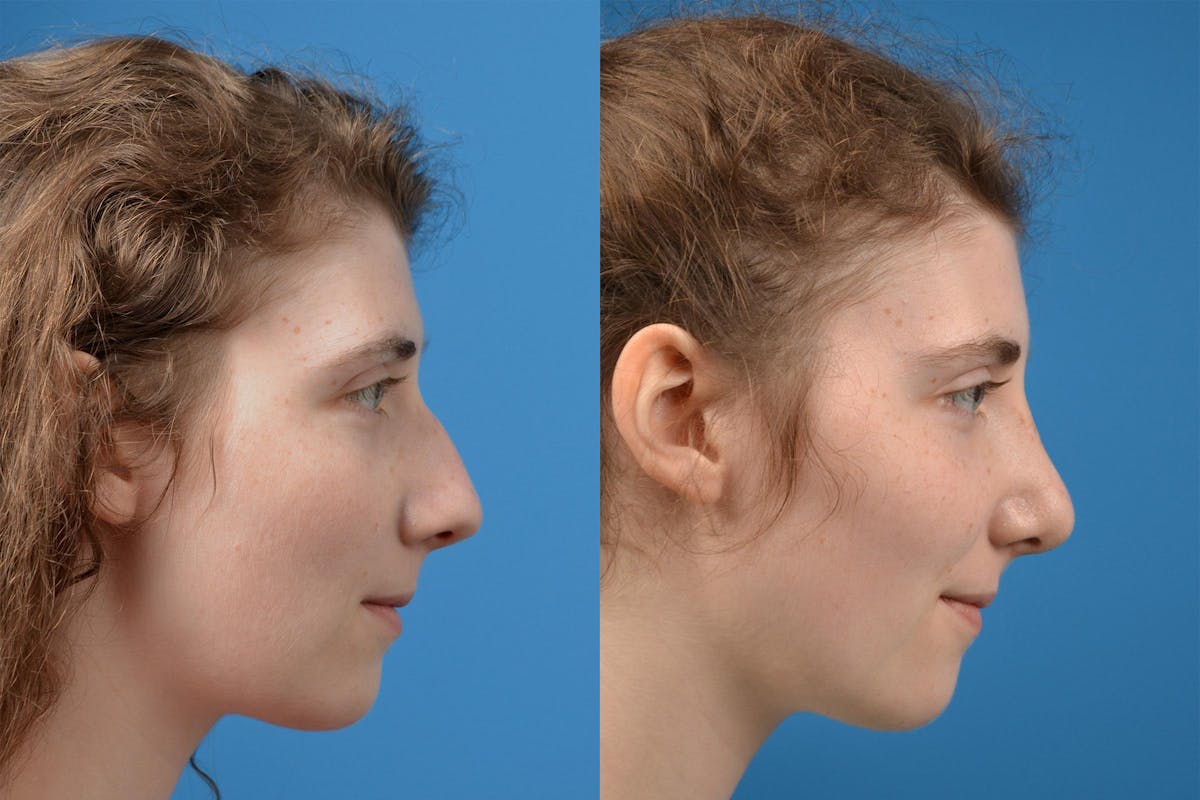 Rhinoplasty Before & After Gallery - Patient 122406825 - Image 3