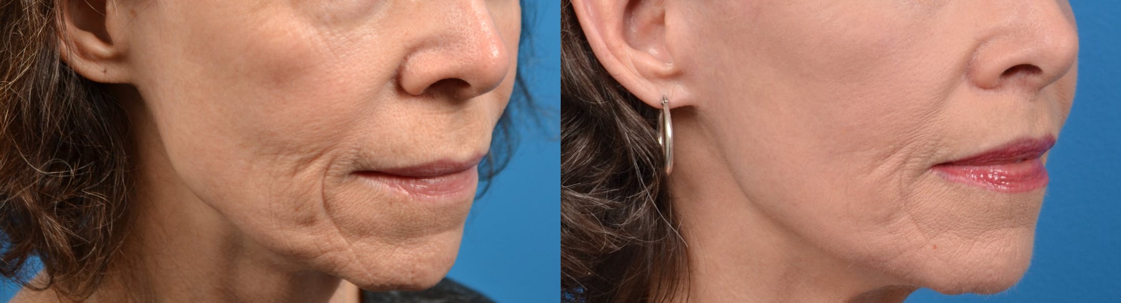 Lip Lift Before & After Gallery - Patient 122406822 - Image 3