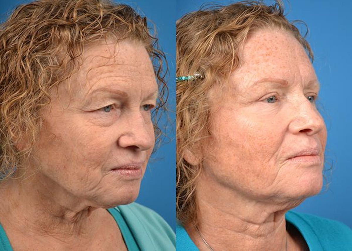 Skin Resurfacing Before & After Gallery - Patient 122406823 - Image 2