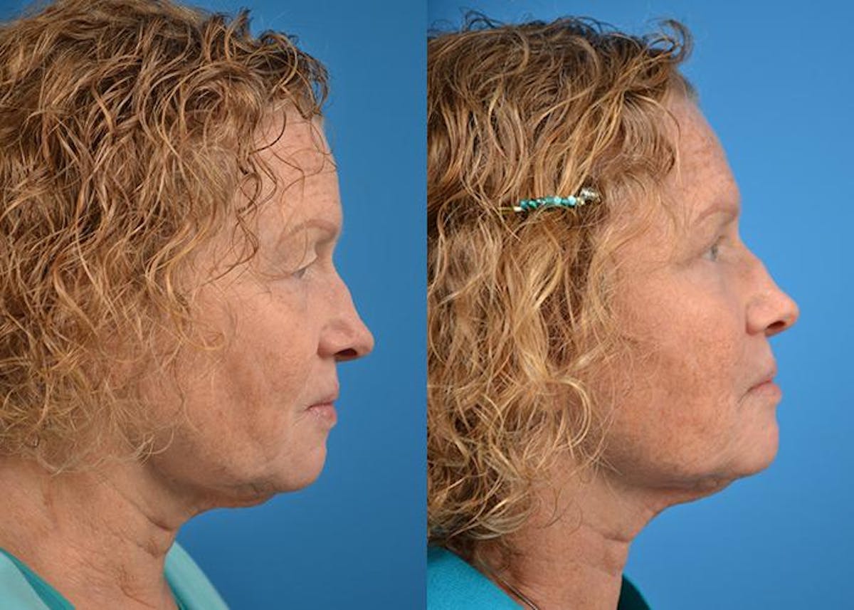 Skin Resurfacing Before & After Gallery - Patient 122406823 - Image 3