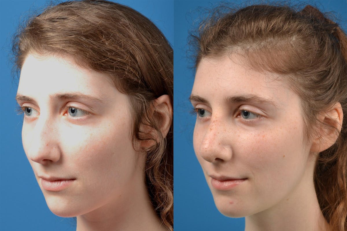 Rhinoplasty Before & After Gallery - Patient 122406825 - Image 4
