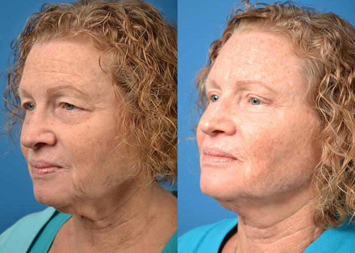 Skin Resurfacing Before & After Gallery - Patient 122406823 - Image 4