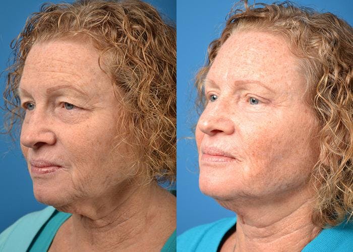 Skin Resurfacing Before & After Gallery - Patient 122406823 - Image 4
