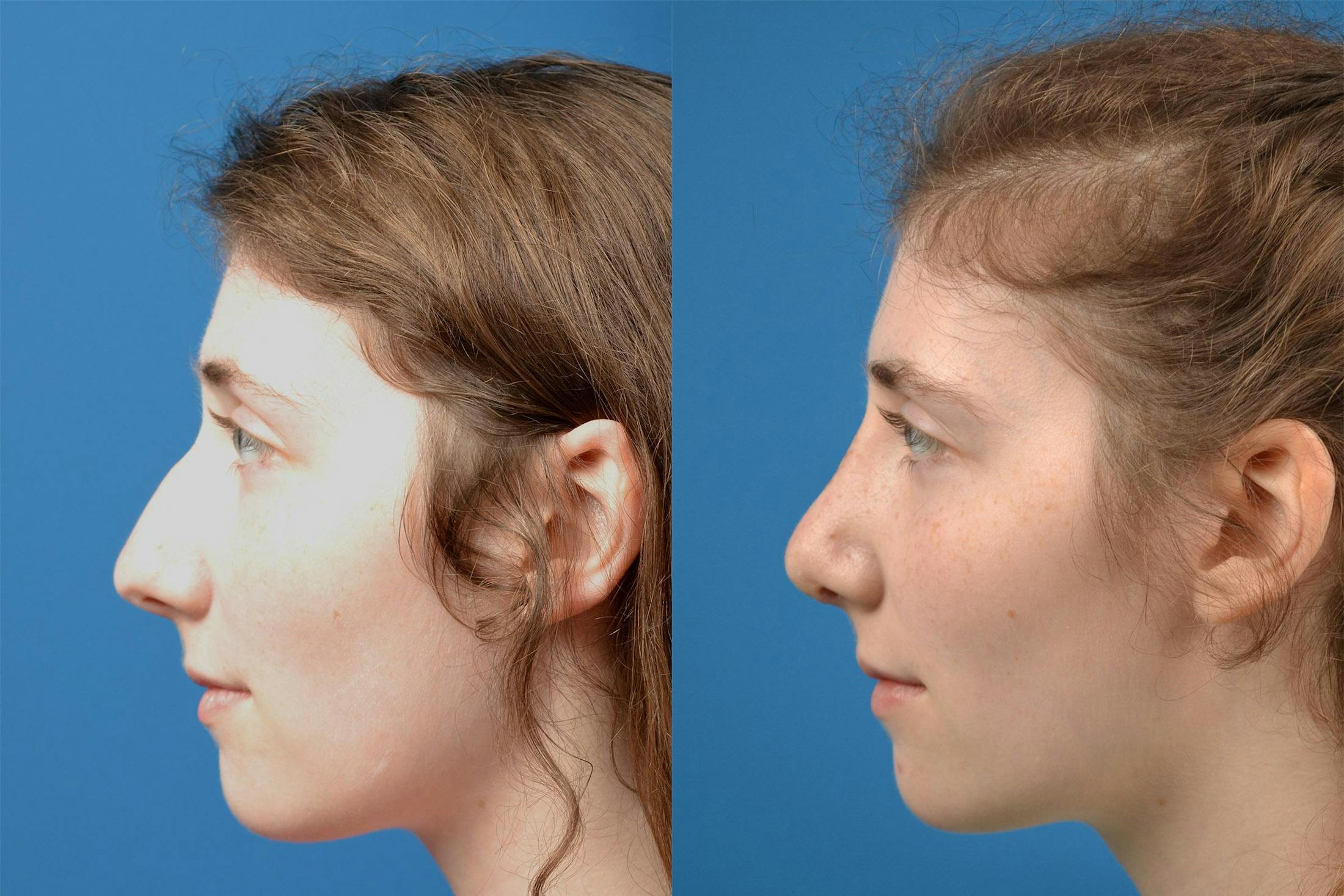 Rhinoplasty Before & After Gallery - Patient 122406825 - Image 5