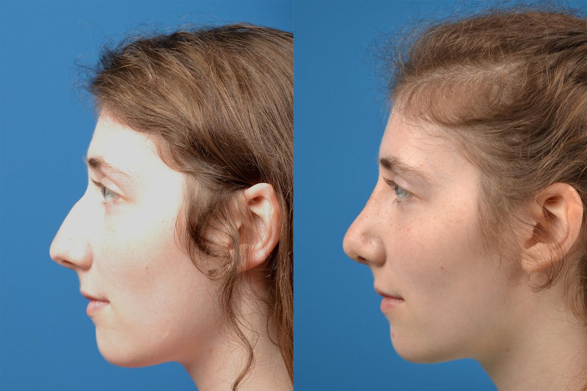 Rhinoplasty Before & After Gallery - Patient 122406825 - Image 5