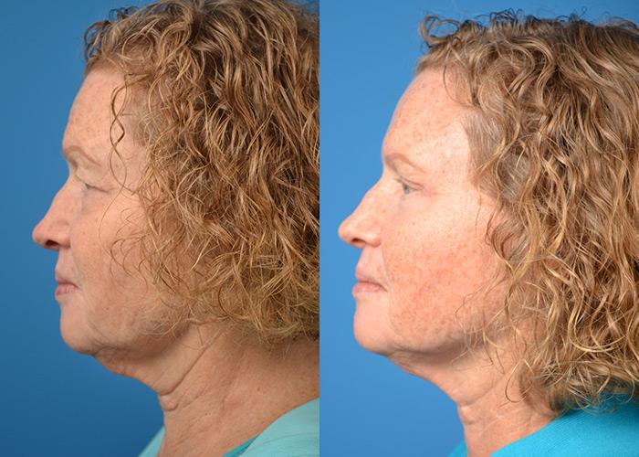 Skin Resurfacing Before & After Gallery - Patient 122406823 - Image 5