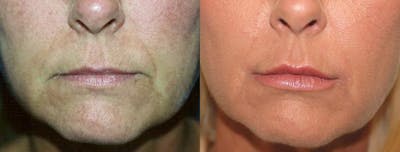 Lip Lift Before & After Gallery - Patient 122406824 - Image 1