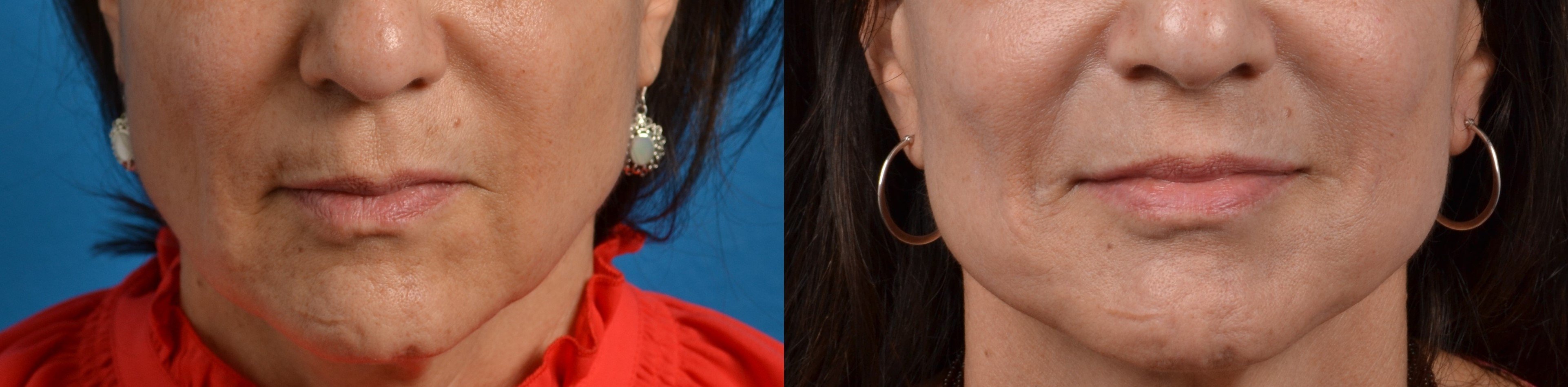 Lip Lift Before & After Gallery - Patient 122406828 - Image 1