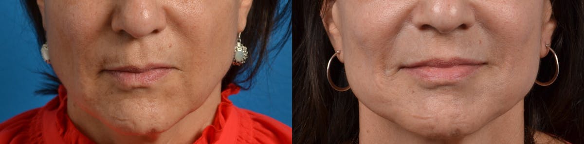 Lip Lift Before & After Gallery - Patient 122406828 - Image 1