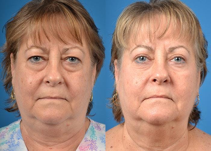 Skin Resurfacing Before & After Gallery - Patient 122406827 - Image 1