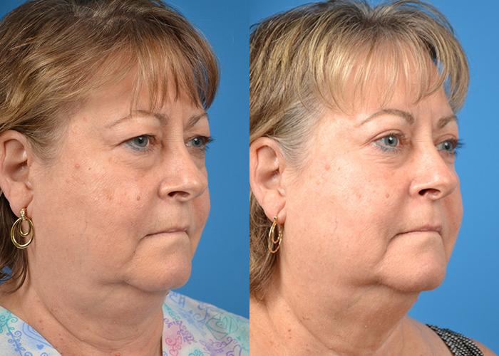 Skin Resurfacing Before & After Gallery - Patient 122406827 - Image 2