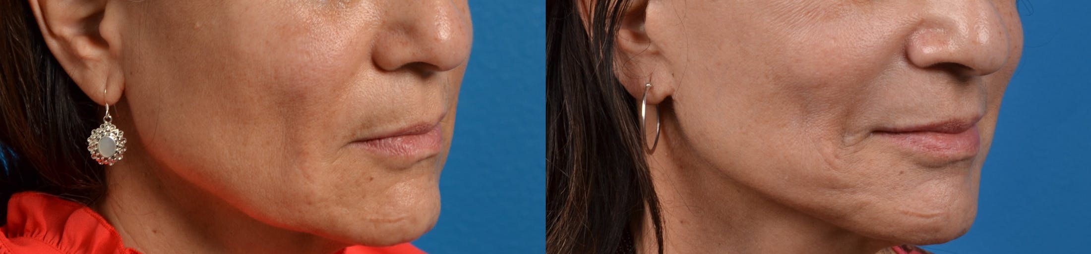 Lip Lift Before & After Gallery - Patient 122406828 - Image 2